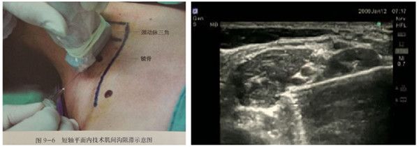 疼痛科锐意开展超声引导下肌间沟臂丛神经麻醉肩关节粘连松解术——