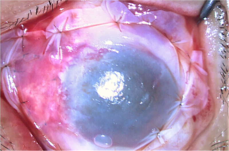 吉大一院郝继龙主任团队成功手术治疗复发性翼状胬肉伴睑球粘连一例