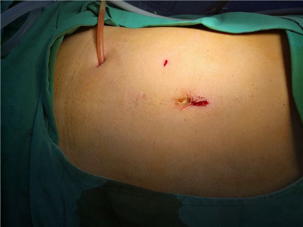 胃结直肠外科腹部无切口结直肠手术(noses)再有新突破