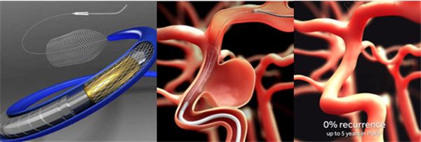 pipeline flex血流导向装置也称作密网支架(covidien neurovascular