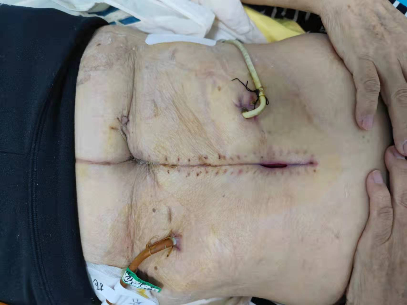 术后难愈切口治疗前后对比同时,也特别感谢胃结直肠外科,胸外科,泌尿